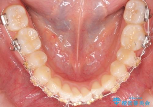 抜かない、削らない矯正 大人も上顎を骨から広げますの治療中