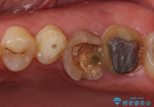 長い間虫歯を放置　奥歯のブリッジ治療の治療前