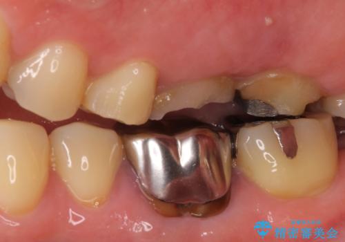 長い間虫歯を放置 奥歯のブリッジ治療の治療前
