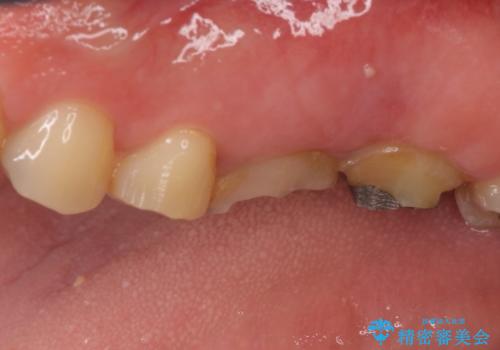 長い間虫歯を放置 奥歯のブリッジ治療の治療前
