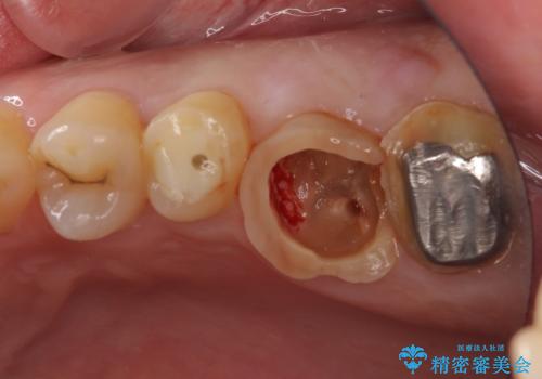 長い間虫歯を放置　奥歯のブリッジ治療の治療中