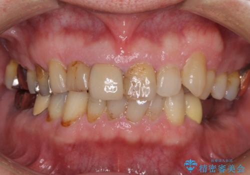 差し歯(被せ物)のやりかえ 上の前歯で印象が明るくの治療前