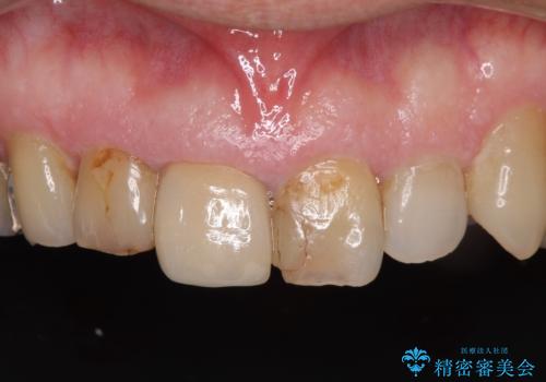 差し歯(被せ物)のやりかえ 上の前歯で印象が明るくの治療前