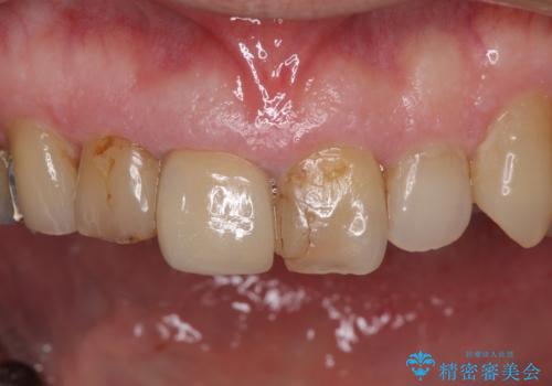 差し歯(被せ物)のやりかえ 上の前歯で印象が明るくの治療前