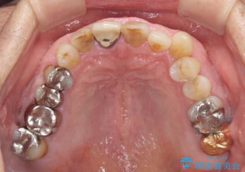 差し歯(被せ物)のやりかえ　上の前歯で印象が明るくの治療前