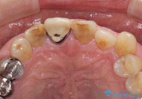 差し歯(被せ物)のやりかえ　上の前歯で印象が明るくの治療前