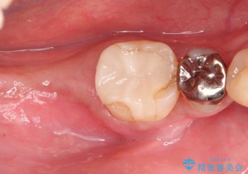 奥歯が痛い。骨増生を併用したインプラントの治療前