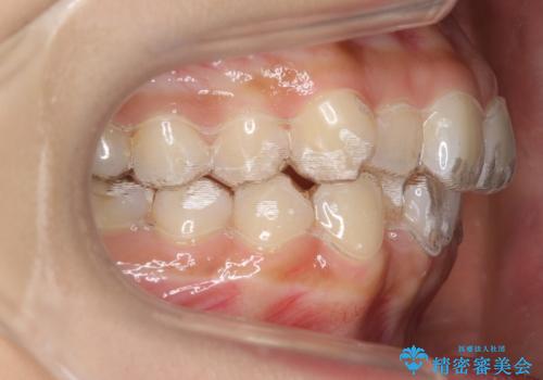 犬歯のねじれ　下の歯のがたがた　インビザラインでの治療中