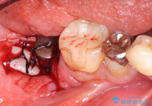 奥歯が痛い。骨増生を併用したインプラントの治療後