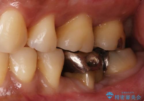 見えない歯周病　長期予後を見据えてインプラントにの症例 治療前