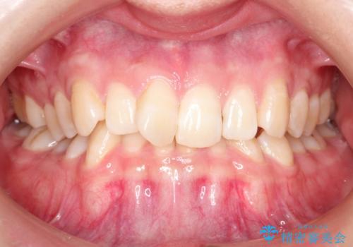 ハーフリンガル　ワイヤー矯正による非抜歯・過蓋咬合の治療の症例 治療前
