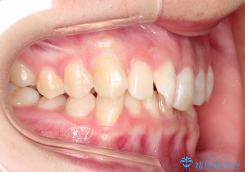 ハーフリンガル ワイヤー矯正による非抜歯・過蓋咬合の治療の治療前