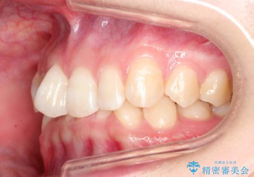 ハーフリンガル ワイヤー矯正による非抜歯・過蓋咬合の治療の治療前
