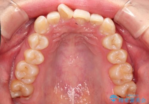 ハーフリンガル　ワイヤー矯正による非抜歯・過蓋咬合の治療の治療前