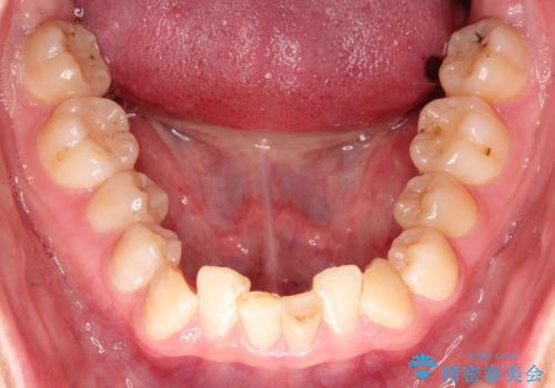 ハーフリンガル　ワイヤー矯正による非抜歯・過蓋咬合の治療の治療前