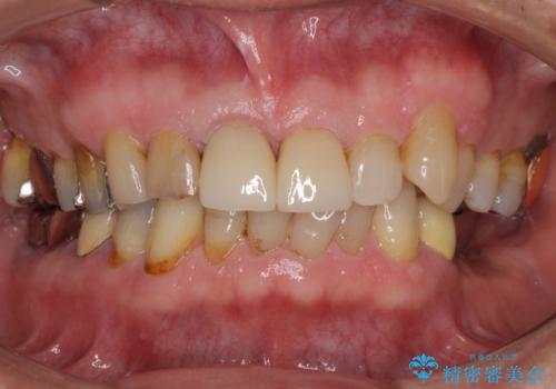 差し歯(被せ物)のやりかえ 上の前歯で印象が明るくの治療後