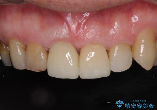 差し歯(被せ物)のやりかえ 上の前歯で印象が明るくの治療後