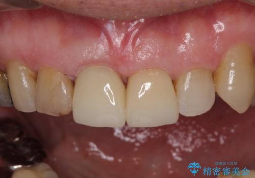 差し歯(被せ物)のやりかえ　上の前歯で印象が明るくの治療後