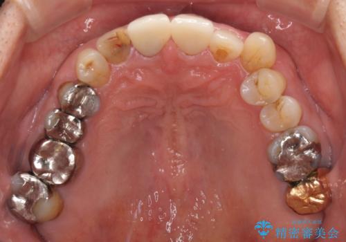 差し歯(被せ物)のやりかえ 上の前歯で印象が明るくの治療後