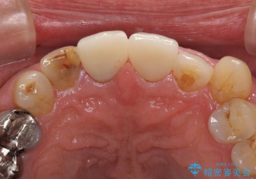 差し歯(被せ物)のやりかえ　上の前歯で印象が明るくの治療後