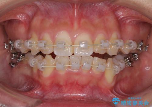 前歯が八重歯でガタガタ ワイヤーによる抜歯矯正の治療中
