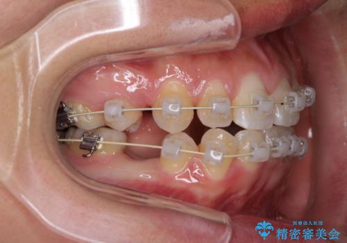 前歯が八重歯でガタガタ ワイヤーによる抜歯矯正の治療中