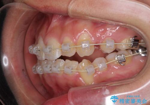 前歯が八重歯でガタガタ ワイヤーによる抜歯矯正の治療中