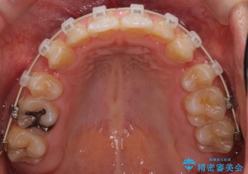 前歯が八重歯でガタガタ　ワイヤーによる抜歯矯正の治療中