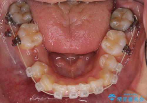 前歯が八重歯でガタガタ　ワイヤーによる抜歯矯正の治療中