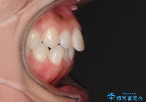 前歯の叢生を治したい　インビザラインによる矯正治療の治療前