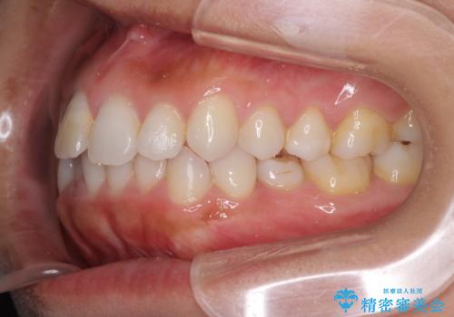 前歯の叢生を治したい　インビザラインによる矯正治療の治療前