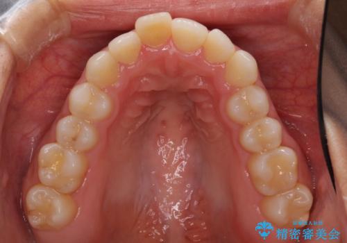 前歯の叢生を治したい インビザラインによる矯正治療の治療前