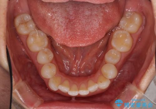 前歯の叢生を治したい インビザラインによる矯正治療の治療前