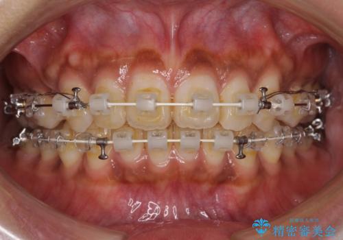 着色した歯肉のピーリング 黒ずみ除去の治療前