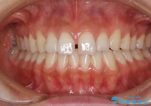 前歯の隙間をオールセラミックで閉じるの治療前