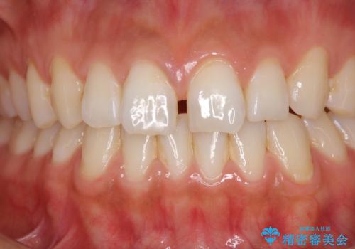 前歯の隙間をオールセラミックで閉じるの治療前