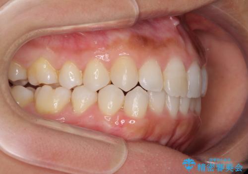 前歯の叢生を治したい　インビザラインによる矯正治療の治療中