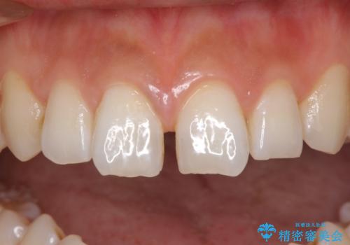 前歯の隙間をオールセラミックで閉じるの症例 治療前