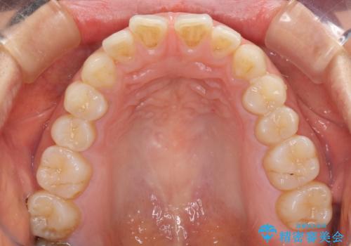 前歯の隙間をオールセラミックで閉じるの治療前