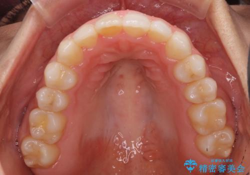 前歯の叢生を治したい　インビザラインによる矯正治療の治療中