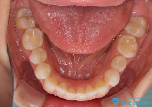 前歯の叢生を治したい インビザラインによる矯正治療の治療中