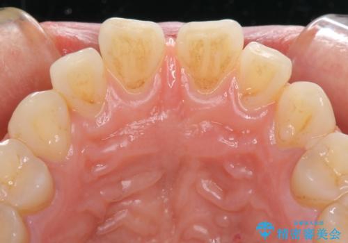 前歯の隙間をオールセラミックで閉じるの治療前