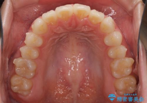デコボコで飛び出した前歯をきれいに　インビザラインによる矯正治療の治療中