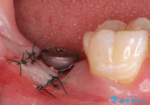 [20代男性] インプラント　失った歯の治療の治療後
