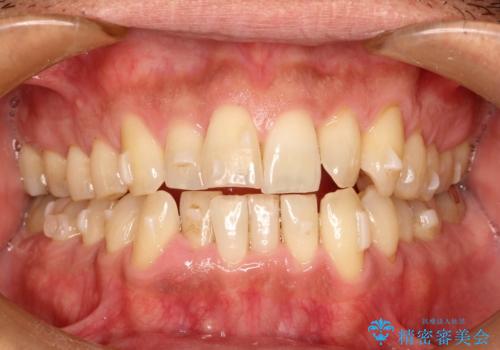 インビザライン invisalign ガタつきを治すマウスピース矯正の治療中