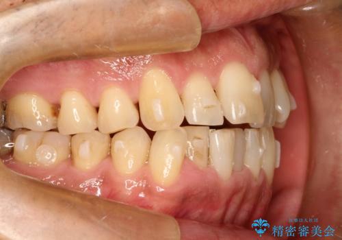 インビザライン invisalign ガタつきを治すマウスピース矯正の治療中