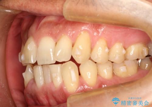 インビザライン invisalign ガタつきを治すマウスピース矯正の治療中