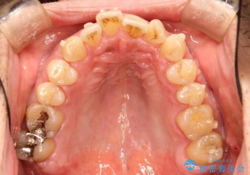 インビザライン invisalign ガタつきを治すマウスピース矯正の治療中