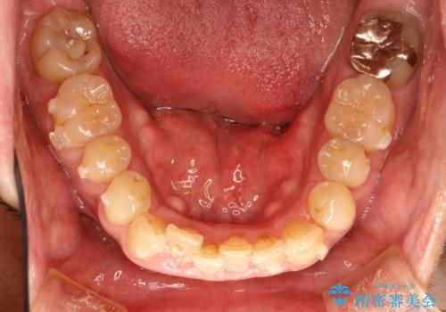 インビザライン invisalign ガタつきを治すマウスピース矯正の治療中