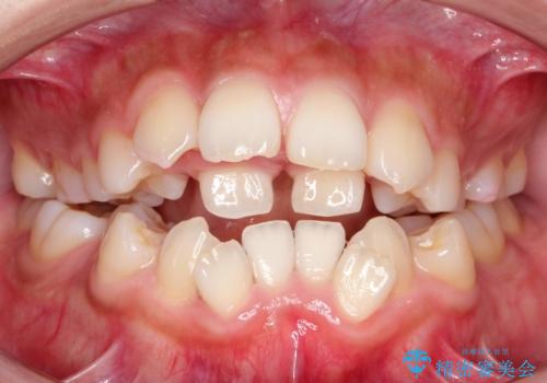 人生が変わる 困難を極める咬合状態に歯列矯正単独で挑戦するの治療前